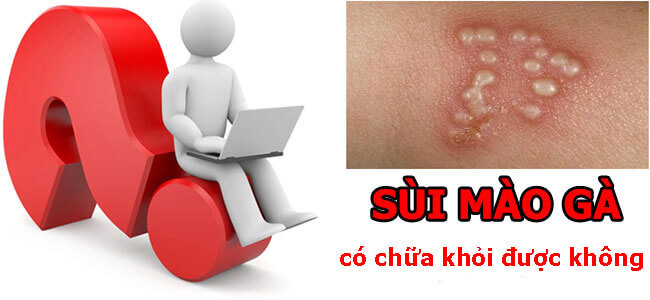 Bệnh sùi mào gà có chữa khỏi được không?